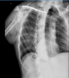 rib breaks Oct 24 xray.png