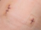 stitches-on-human-skin.jpg