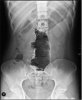 ABDOMINAL X-RAY copy.jpg